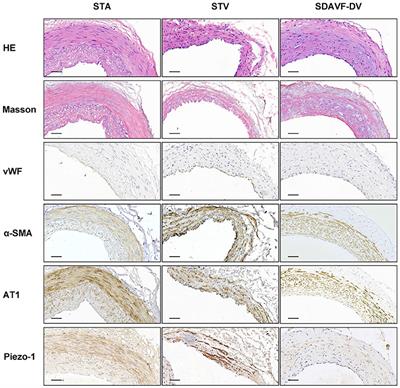 Pathology and Protein Changes of the Spinal Dural Arteriovenous Fistula Arterial Draining Vein Under Sustained High Vascular Pressure